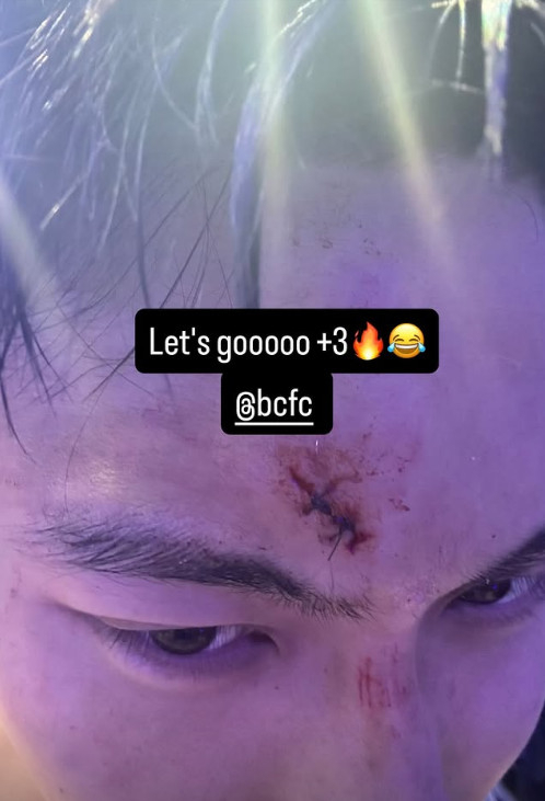 Baek Seung-ho posted a picture of his forehead on his social media (SNS) on the 5th (Korea Standard Time) and said, "Three points, let's go." /Photo = Baek Seung-ho's SNS farewell