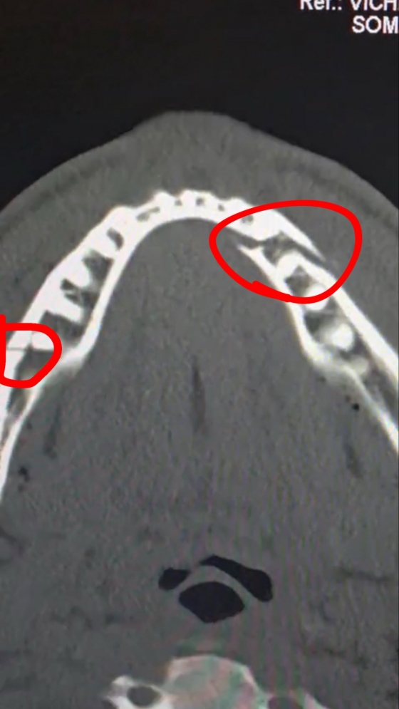 图为杰克-保罗和joshua在比赛结束后公开的颌骨骨折X光片。 =照片:杰克-保罗个人社交网络服务(SNS)