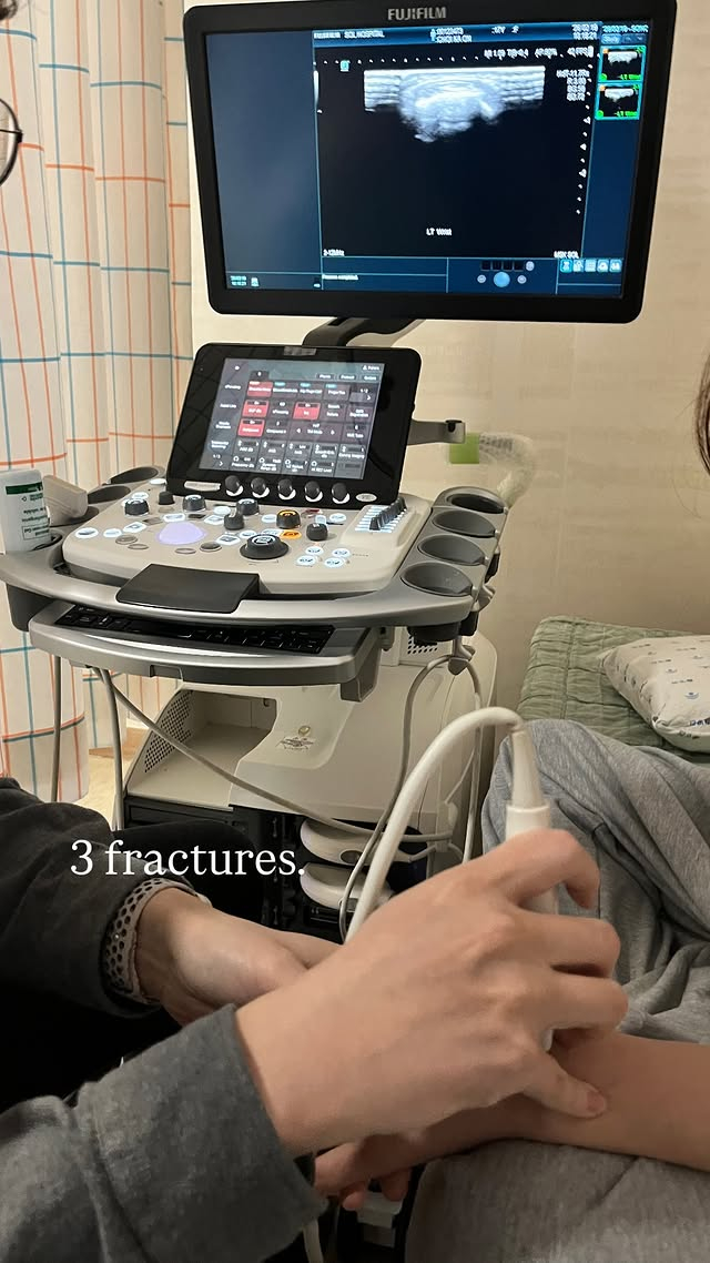 19日,崔佳温(音)通过社交媒体上传的医院检查照片上写着"3 fractures(骨折)"字样,告知了手掌骨骨折诊断的消息。 =照片=崔佳温SNS截图。