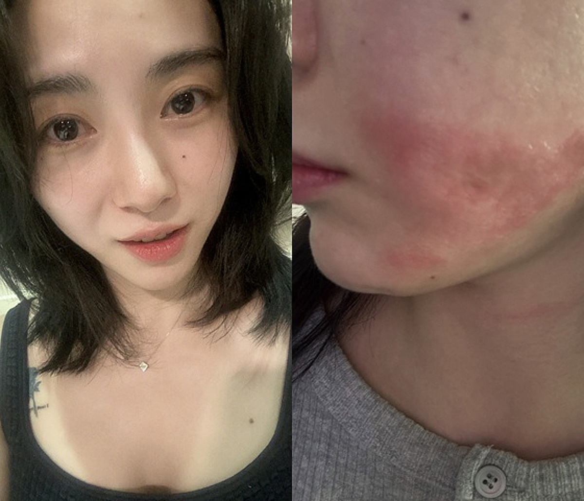 권민아, 슈링크 의료사고→4개월 지난 흉터도 '심각' "1억 손해..병원서 협박죄라며 연락하지 말라고" [스타이슈]