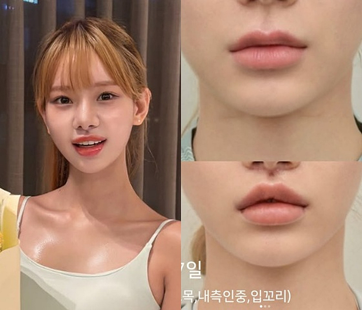 맹승지, 인중축소술 大만족 "12년 만 수술..더 어려보이는 듯" [스타이슈]