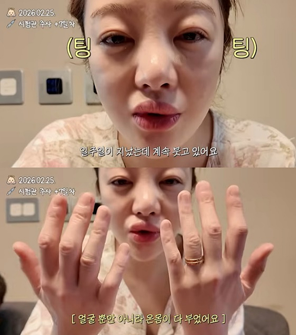 42세 황보라, 시험관 주사 부작용으로 얼굴 '퉁퉁'..각막까지 손상 "만신창이"