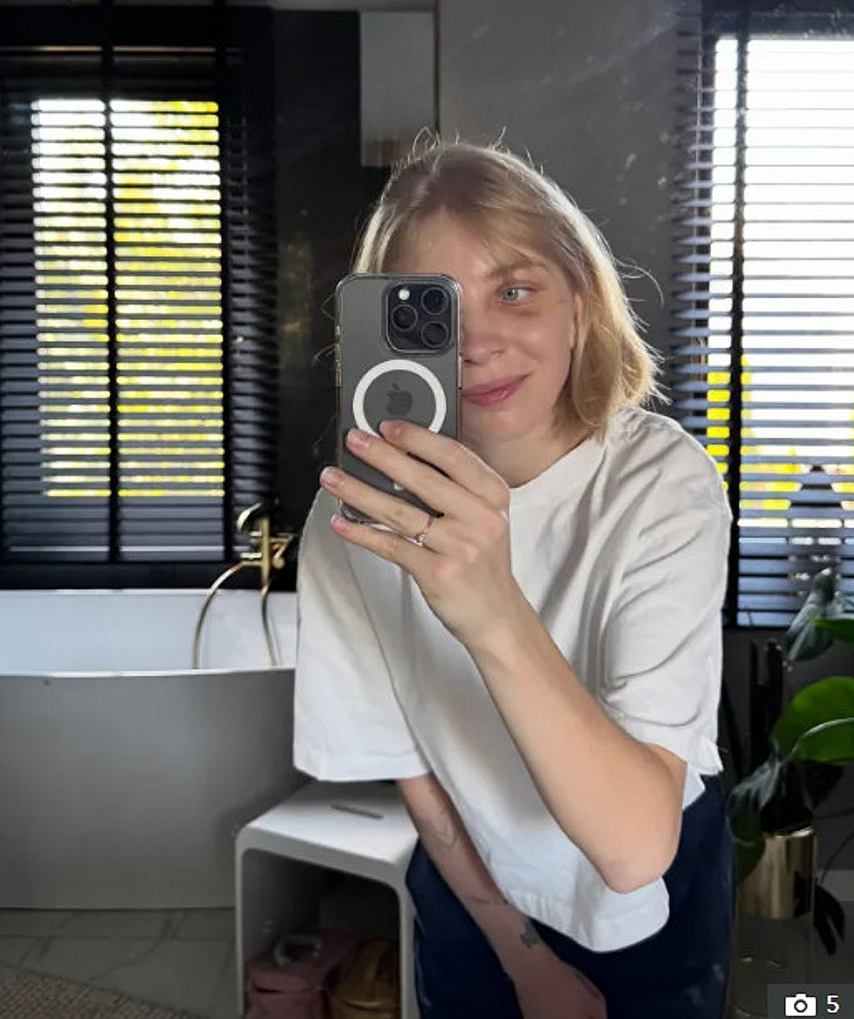 스케이트 날에 실명 위기 "눈 밑에 티타늄 박았다" 고백... 女 쇼트트랙 스타 '가려왔던 흉터' 생방송서 공개