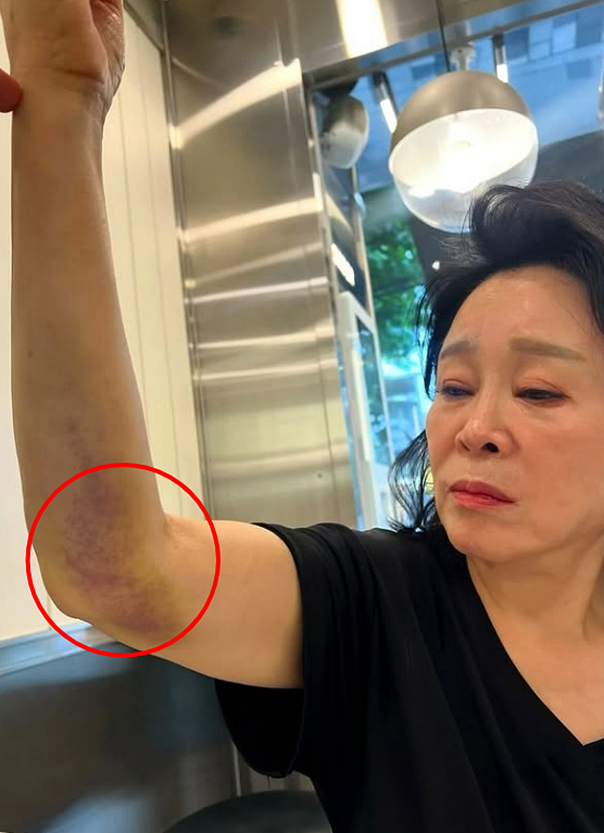미자 母, 욕실서 쓰러지더니..팔에 멍 가득 "71세 뼈 안 부러져 행운" [스타이슈]