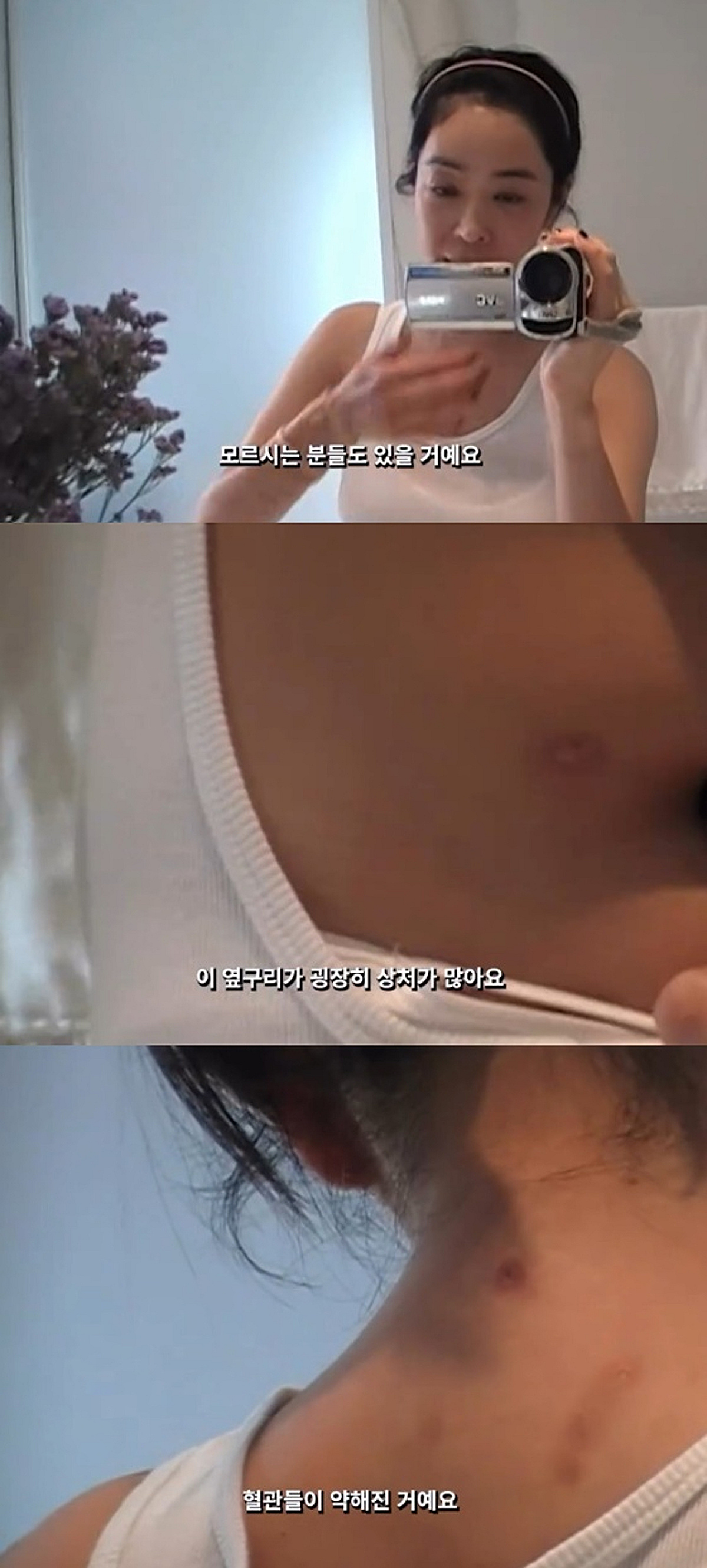 '폐암' 이혜영, 수술 절제 부위→주사 흉터 공개 "안 예뻐서 속상" [스타이슈]