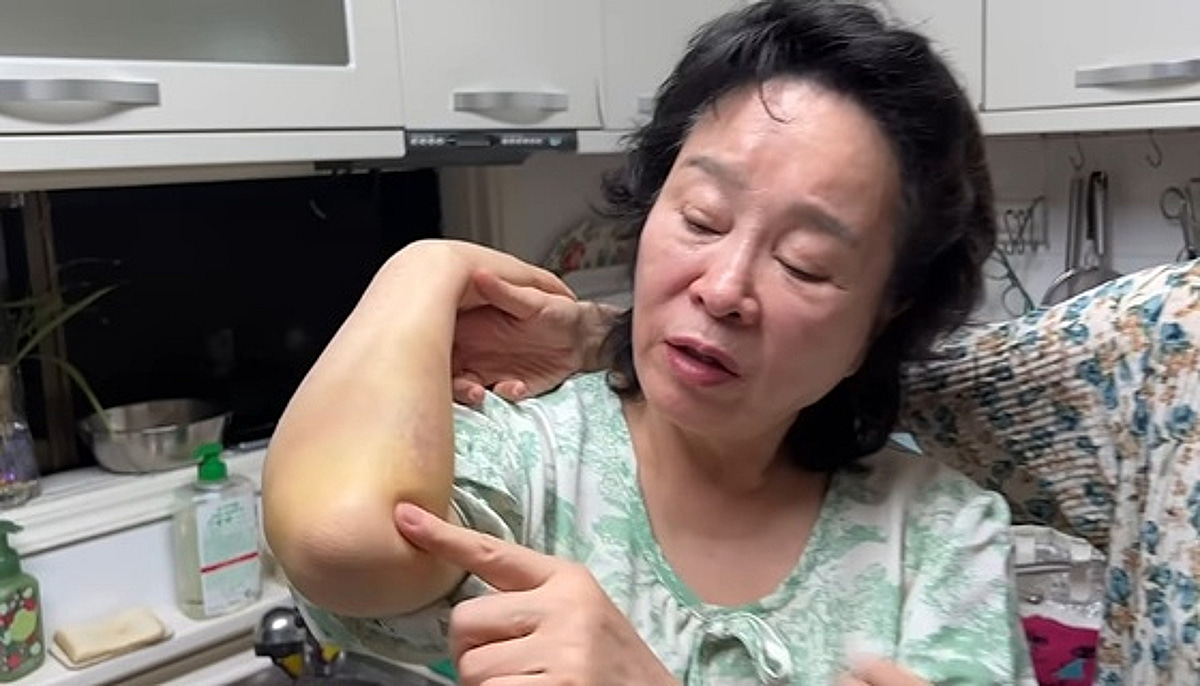 전성애, 낙상 사고로 온몸에 멍 자국..미자 "의식 잃어, 돌아가신 줄 알았다"