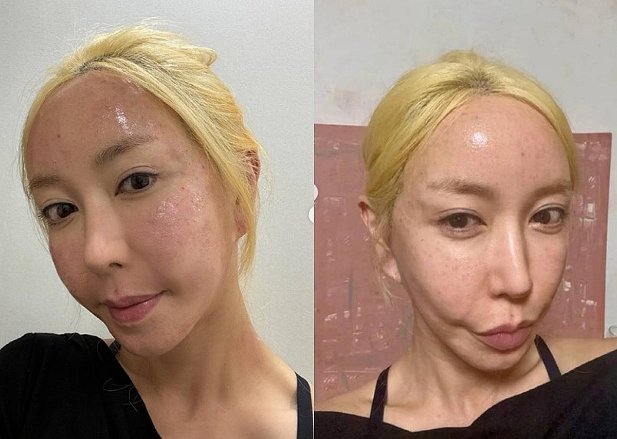 슈, 시술 직후 민낯 그대로 공개했다가 '삭제'.."따갑고 빨개져"