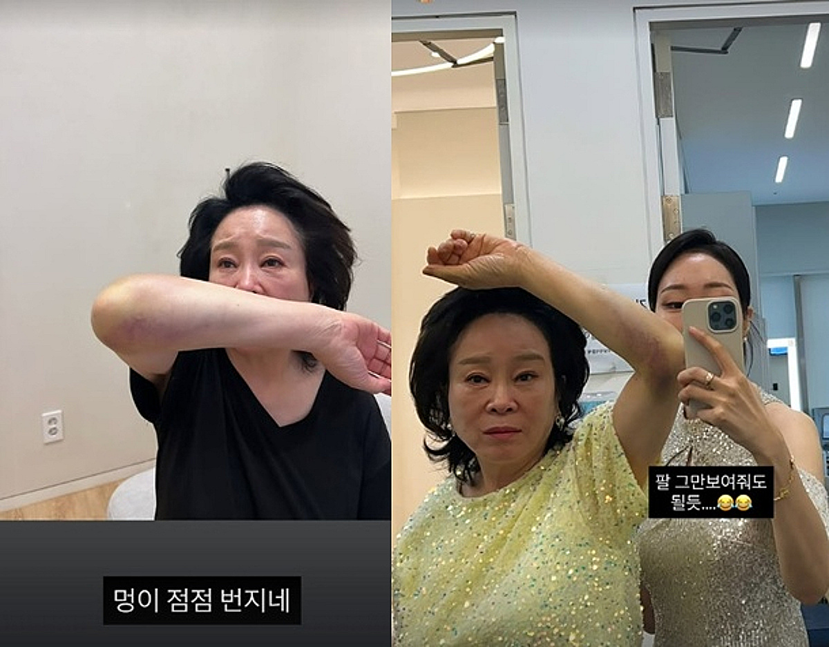 욕실서 쓰러진 '미자 母' 전성애, 사고 그 후.."멍이 점점 번지네" [스타이슈]