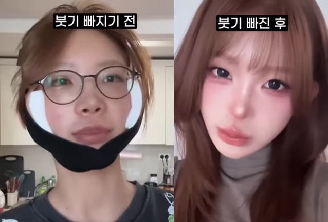 '광대성형' 최준희 전후 모습 보니.."이번엔 좀 무서웠다"[스타이슈]