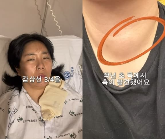 허안나, 충격 근황..목에서 혹 발견→갑상선 75% 제거 수술