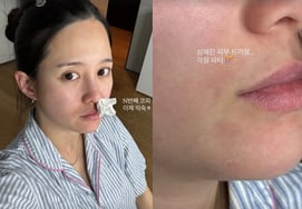 Nam Bora (SNSD) chia sẻ hình ảnh đáng tiếc khi chảy máu cam lần thứ N gây ra vấn đề về da