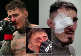 "汚い手のせいで··· 顔をぶっ壊してやる「致命的な失明危機に陥ったUFCチャンピオン、突然の復帰宣言→引退示唆を撤回」