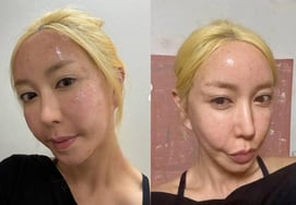 Шу, сразу после процедуры он раскрыл лицо без макияжа, а затем «удалил»."Это горячо и покраснело"