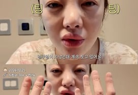 Hwang Bo Ra - 42 tuổi khoe gương mặt sưng húp vì tác dụng phụ của việc tiêm ống nghiệmTổn thương đến giác mạc "chấn thương đầy mình"