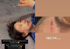 イ・サンア、今回は額が大きく裂けて「X」の罵りが自然に..「警察出動騒動」に続く3月の重なる不測の事態 [スター・イシュー]