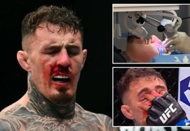 衝撃「4分間で目が3回刺された」" UFCチャンピオン、血の涙に怒るのも無理はない··· "手術を2回受けたが復帰は挫折"