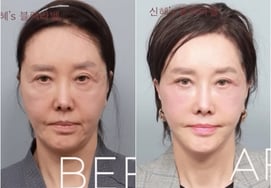 '63 años' Yoo Hye-ri, resultado de la cirugía de lifting facial.. rejuvenecimiento a los 30: "Se ha ido la depresión" [Star Issue]