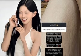 '55kg Weight Loss' Choi Jun-hee Confidently Reveals Stretch Marks: "Like Mermaid Scales"