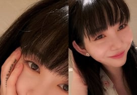 'Claiming 100 million won in damages' Kwon Min-ah, Shrink Medical Malpractice → Scar Recovery in Just Six Months? [Star Issue]