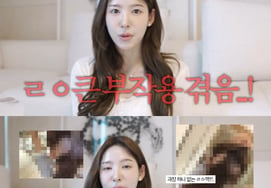 "JTBC's air conditioner isn't working," said Lee Na-yeon, confessing to baldness: "Side effects of hair transplant"
