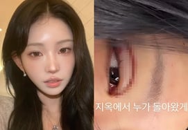 '故チェ・ジンシルの娘'チェ・ジュンヒ、腫れた目..二重まぶた手術「地獄から誰が戻ってきたのか」 [スター・イシュー]