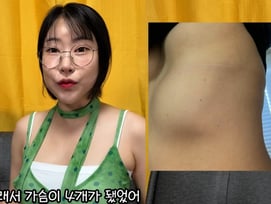 "가슴이 4개가 돼" 이세영, 갈비뼈까지 내려온 '필러 부작용' 사진 최초 공개[스타이슈]