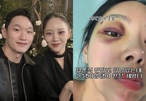 Kim Seul-ki, "Oksun" from Season 10 of "I Am Solo," has her wedding to Yoo Hyeon-cheol just around the corner, yet she reveals a badly bruised eye, prompting maximum concern: "My eye is completely black and blue" → "Did you get hit?" [Star Issue]