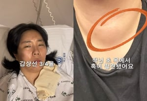 Comedian Heo An-na reveals shocking update: lump found in neck → surgery to remove 75% of thyroid gland
