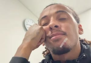 Shocking: "Three teeth pierced through my lip"… Defender's face mangled by a murderous tackle, yet he still says, "It hurts a bit, but I'm fine," showcasing a manly fighting spirit