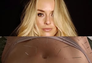 Wearing a thong and undergoing "shocking" acupuncture... Ski goddess "shares directly" her journey: "I am working hard on my rehabilitation" after facing the threat of leg amputation