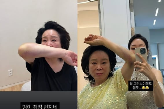 Nữ diễn viên hài Mija ngã trong phòng tắm 'Mẹ của Mija' Jeon Sung-ae, sau sự cố.."Bầm tím lan dần ra" [Star Issue]
