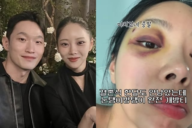 “Oksun de la temporada 10”, Kim Seul-ki, con su boda con Yoo Hyeon-cheol a la vuelta de la esquina… “Ojo completamente morado” → “¿Te golpeaste?” Máxima preocupación [Star Issue]