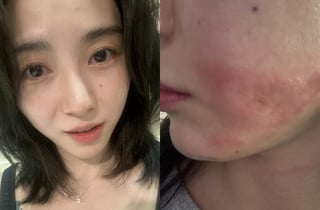 권민아, 슈링크 의료사고→4개월 지난 흉터도 '심각' "1억 손해..병원서 협박죄라며 연락하지 말라고" [스타이슈]